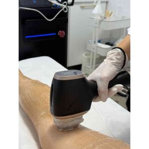 Epilare definitivă cu laser și IPL