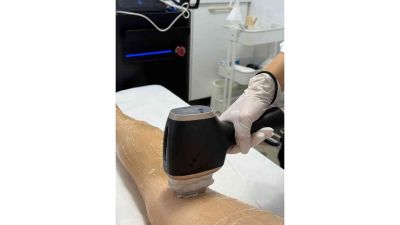 Epilare definitivă cu laser și IPL