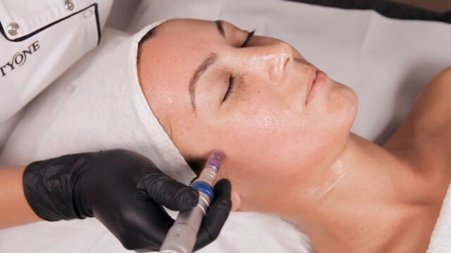 Peeling Chimic si Microneedling