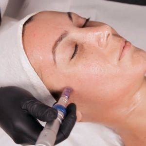 Microneedling